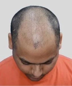 Hair Transplant Before Results - Best Hair Transplant in Delhi