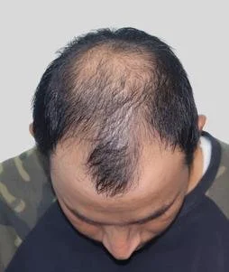 Hair Transplant Before Results - Best Hair Transplant in Delhi