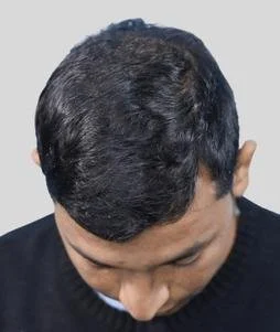 Hair Transplant After Results - Best Hair Transplant Clinic in Delhi