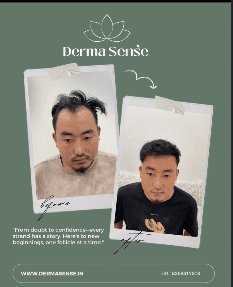 Hair Transplant Before and After Client 1