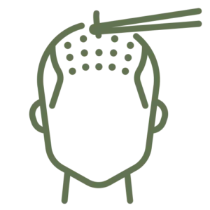 Advanced Hair Transplant Techniques at Best Hair Transplant Clinic in Delhi